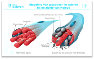 Stapeling van glycogeen in spieren bij de ziekte van Pompe